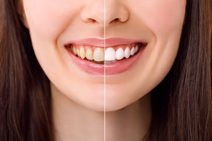 Clear Aligners at Synera Dental Wellness